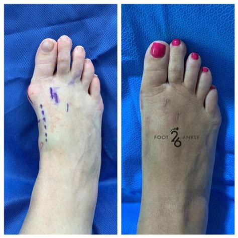 lapiplasty bunion repair